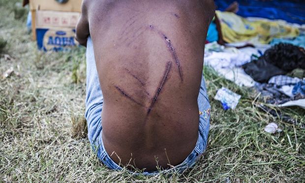 One of migrants housed in a makeshift camp in Langsa, Indonesia, shows the scars he says are from violence that erupted on the boats while still at sea. Photograph: Antonio Zambardino/Guardian