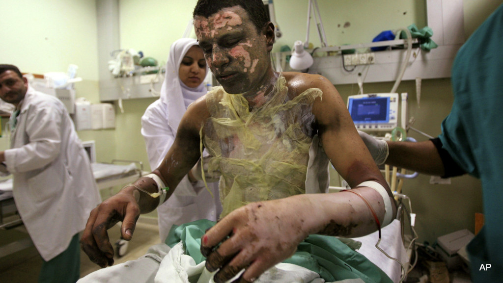In this Sunday, Jan. 11, 2009, file photo, Palestinian Akram Abu Roka is treated for burns at Nasser Hospital in Khan Younis in the southern Gaza Strip. Human Rights Watch issued a report Wednesday, March 25 2009 that Israel fired white phosphorous shells indiscriminately over densely populated Gaza, and that this is evidence of war crimes.