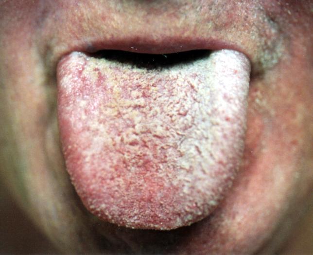 tongue papillae hypertrophy causes ouă fascioliasis